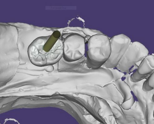 anatomy shape screw implant